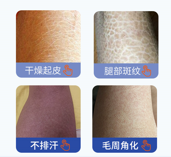 魚鱗皮膚病
