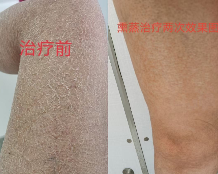 魚鱗病怎么治