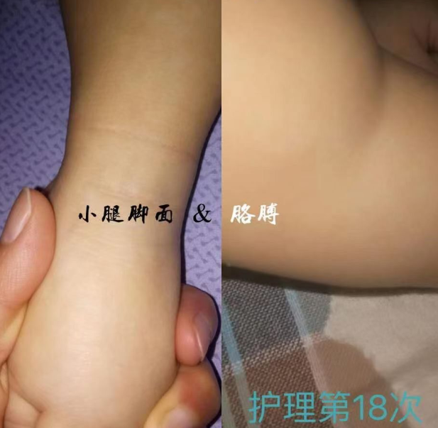 魚(yú)鱗病前后對(duì)比