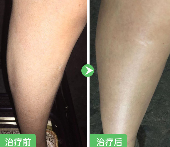 魚(yú)鱗皮膚怎么治